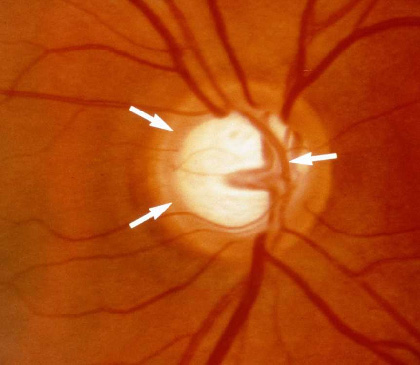 Glaucoma